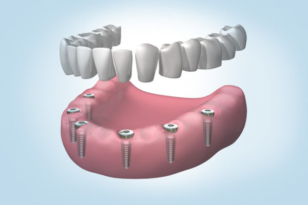 Todos los tratamientos de implantes dentales en Torelló