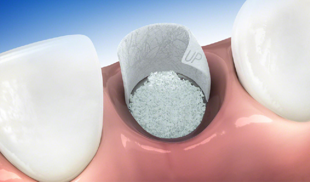 Implantes dentales en Torelló