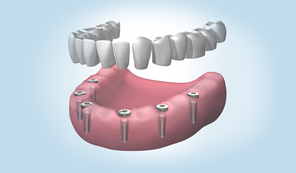 Implantes dentales en Torelló