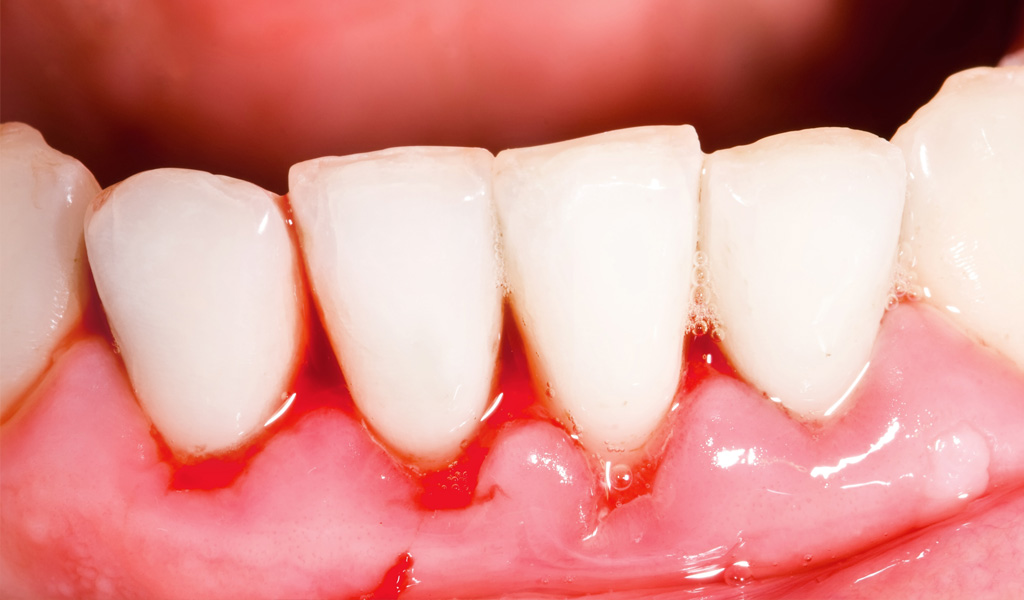 Urgencias dentales en Torelló